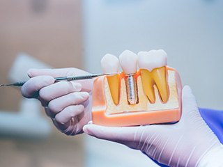 Dentist pointing to a dental implant model