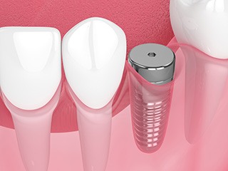 Digital illustration of a dental implant