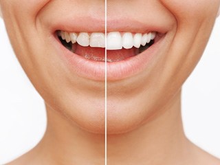 young woman before and after getting veneers 