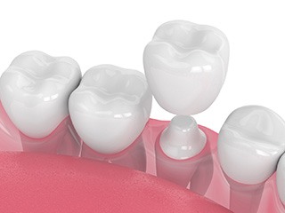 illustration of porcelain dental crown 