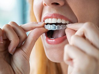 young woman putting on Invisalign tray 