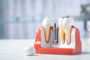 Model showing titanium dental implant between two natural teeth
