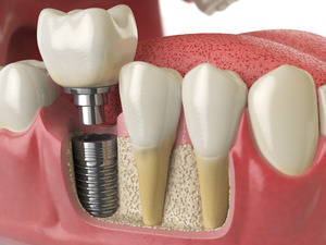 3D render of a dental implant